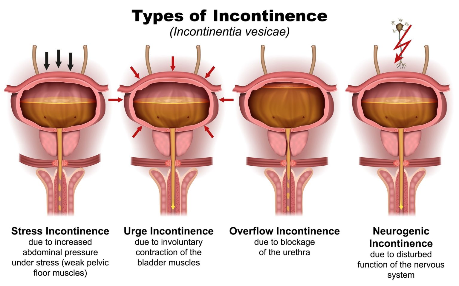 Are Kidney Stones Causing Your Incontinence? Here’s What You Need to ... - Kidney Disease And Incontinence Management