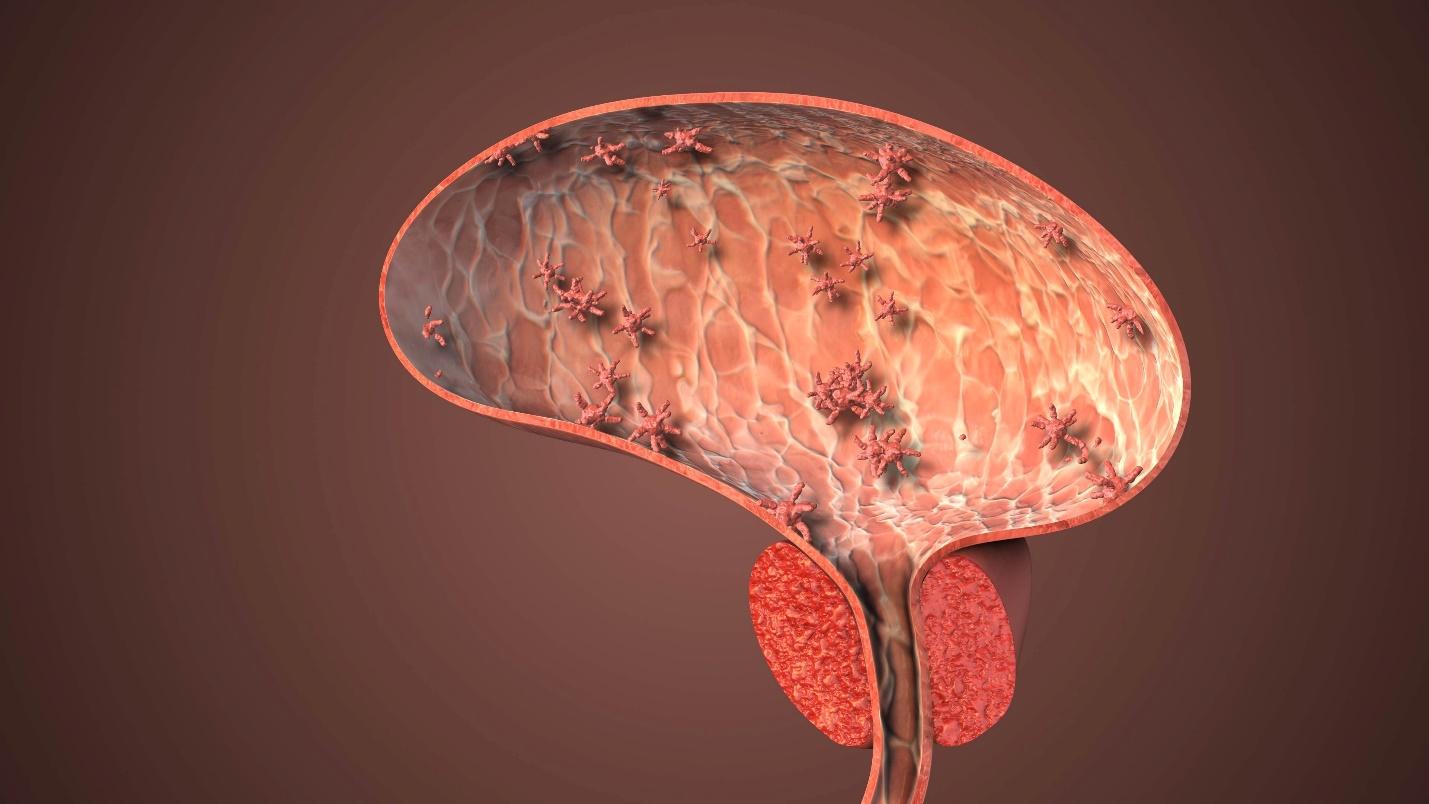 evidence-based strategies for preventing recurrent urinary tract infections.